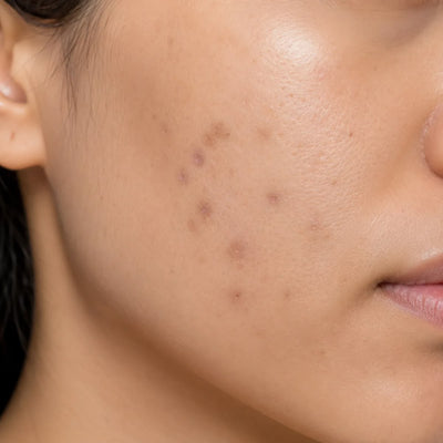 Dark spot reduction